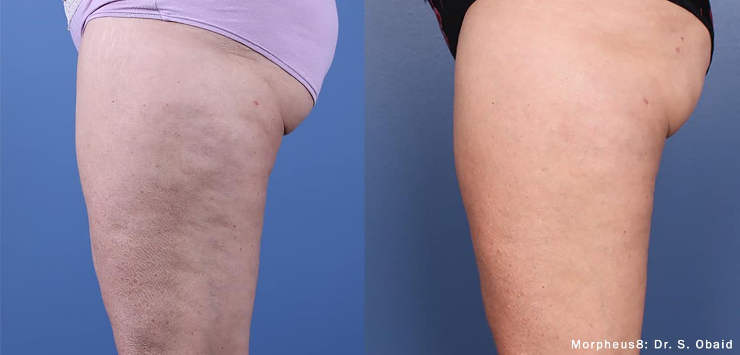 Before and After Image: Morpheus8 - left-side