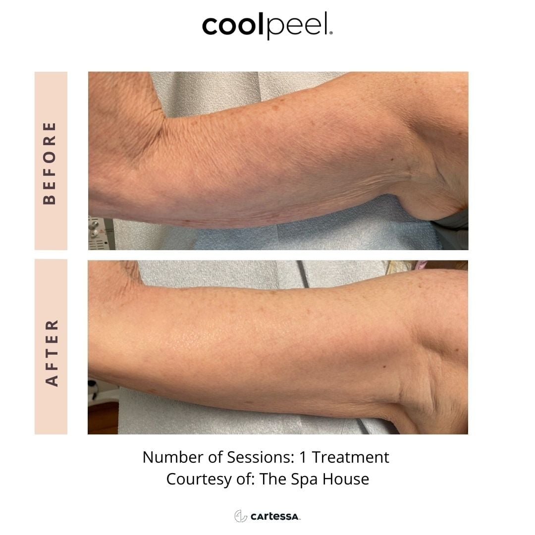 Before and After Image: CoolPeel - front