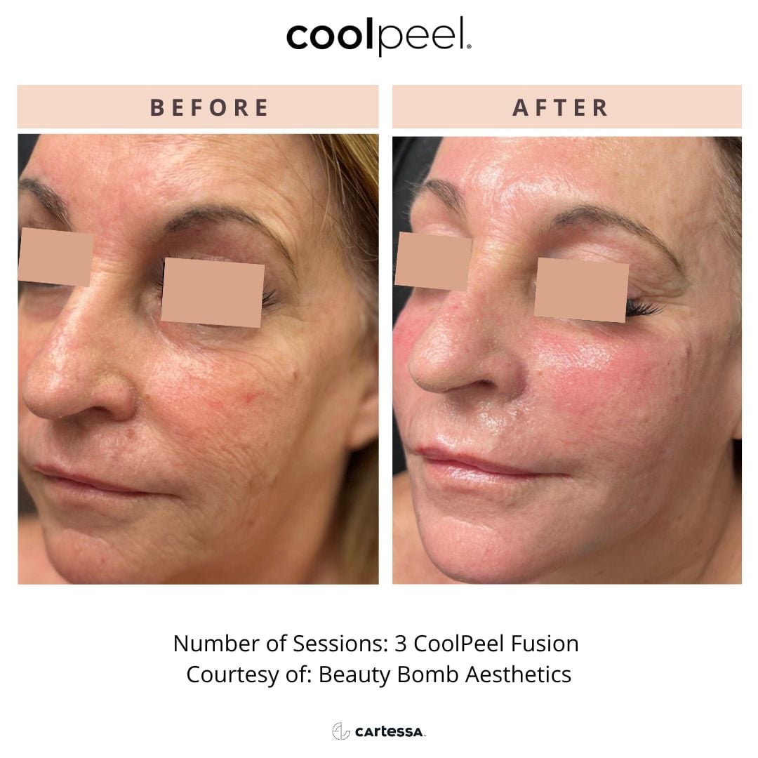 Before and After Image: CoolPeel - front